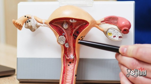 Su Salud: ¿Cómo elegir el mejor método anticonceptivo?