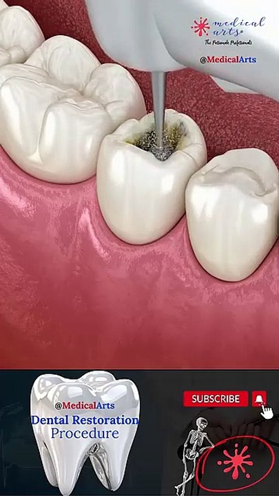 Dental Restoration ↪ Composite Bonding Teeth  ↪ 3D Medical Animation(360P)