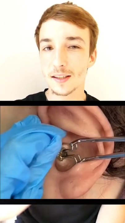 Corps étranger oreille