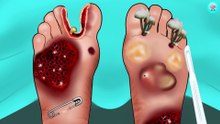 13. ASMR Treatment athletes foot and remove maggot between toes   Foot care animation   Braini ASMR