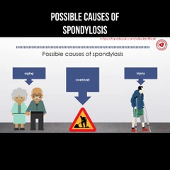 Possible causes of spondylosis