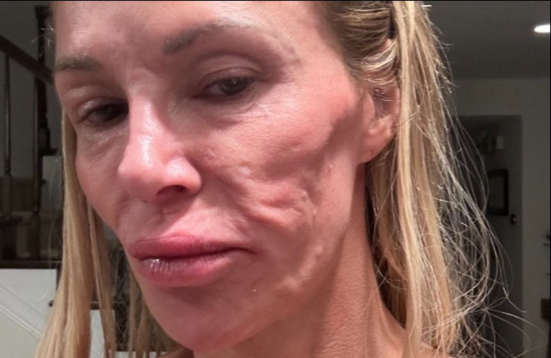 Brandi Glanville is running 'out of' money amid her medical ordeal