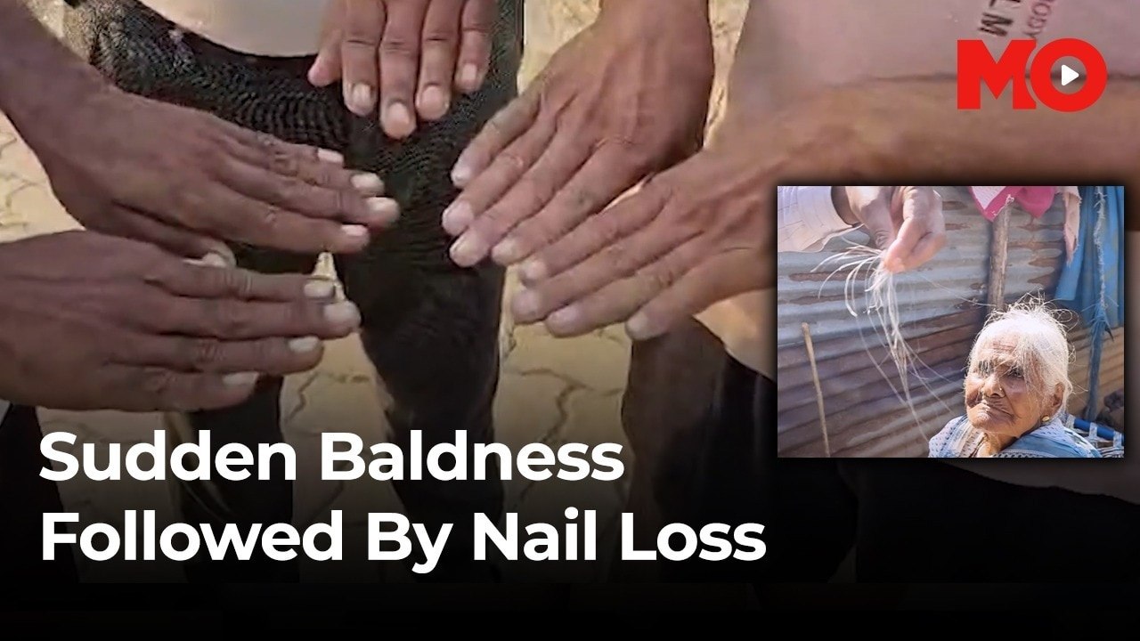 Buldhana’s medical mystery: From hair loss to falling nails