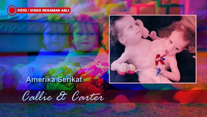 KISAH MENGHARUKAN KEMBAR BERDEMPET DI DUNIA