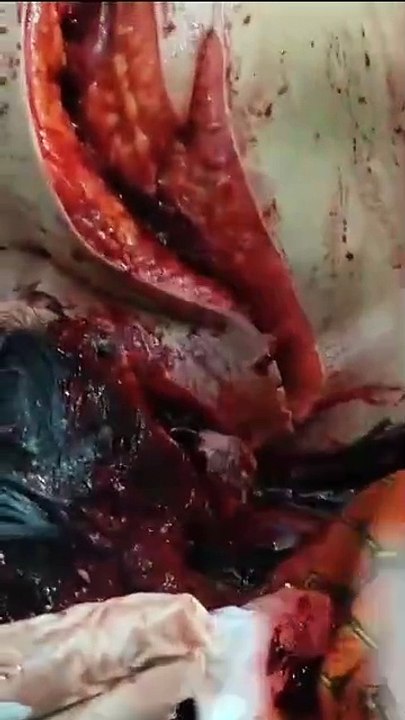 Begal Sabet Leher punggung tangan Korban