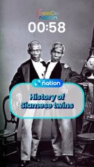 History of Siamese twins