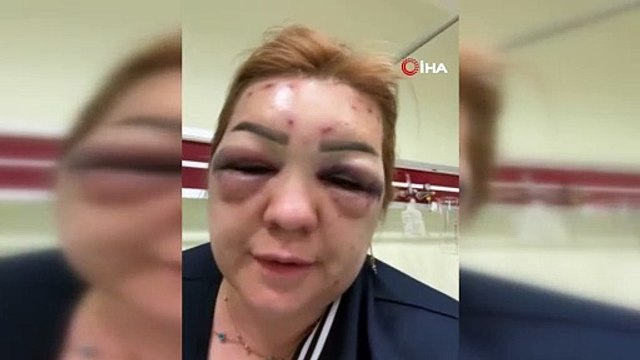 Botoks bu hale getirdi: Yüzü şişti tanınmayacak hale geldi