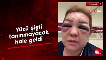 Kahramanmaraş'ta botoks sonrası yüzü şişti tanınmayacak hale geldi