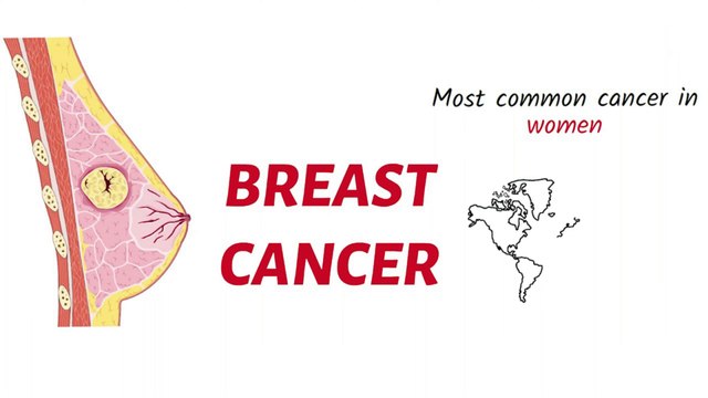 Breast Cancer Causes, Symptoms, Types, and Treatment Explained