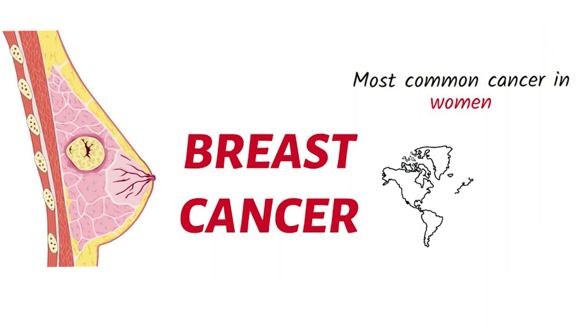 Breast Cancer  Causes, Symptoms, Types, and Treatment Explained