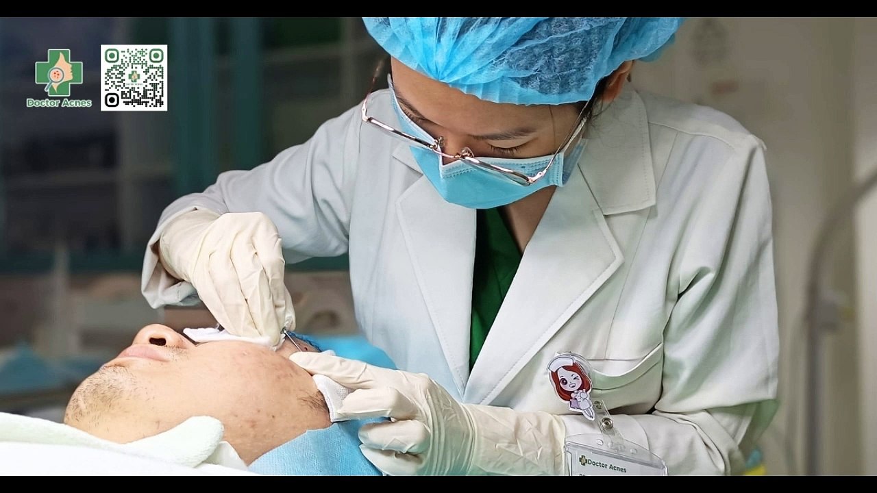 Cắt đáy sẹo rỗ giá bao nhiêu? Địa chỉ cắt đáy sẹo rỗ uy tín