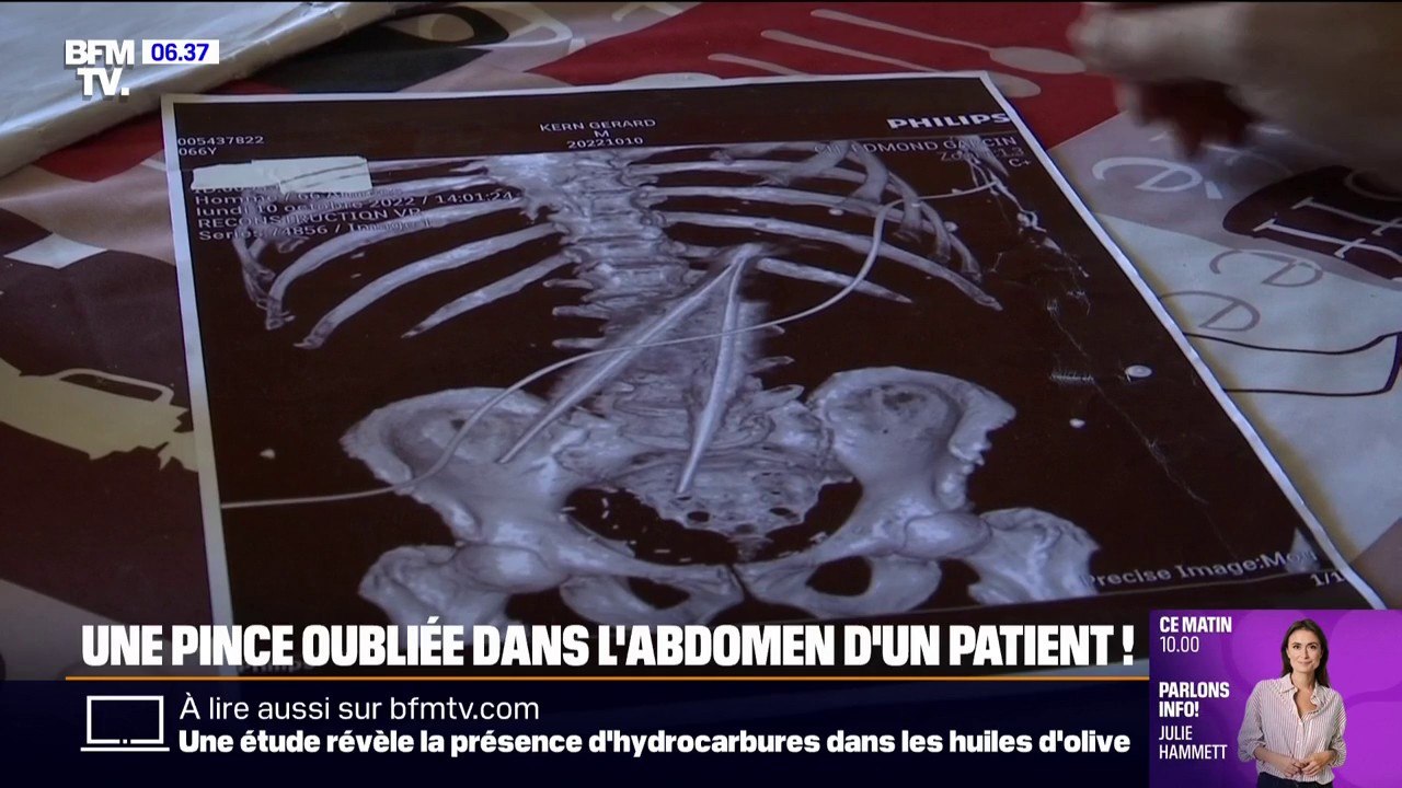 Marseille: une pince chirurgicale de 20 centimètres a été oubliée dans l'abdomen d'un patient