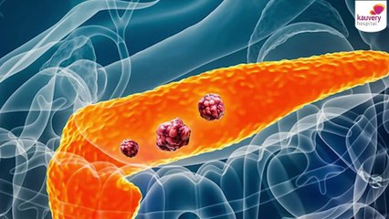 Can Early Diagnosis Help Prevent Pancreatic Cancer?