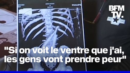"Je n'ose même plus aller à la plage": une pince chirurgicale de 20 centimètres a été oubliée dans l'abdomen d'un patient