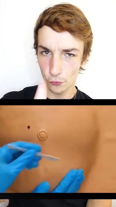La césarienne 🤯