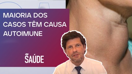 Quais as maiores causas do hipotireoidismo? | Dr. Filippo