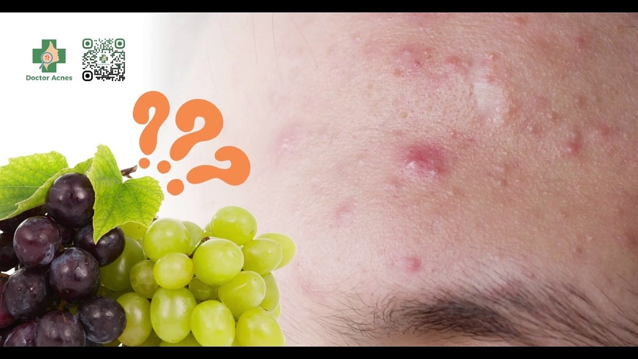 Ăn nho có nổi mụn không? Cách ăn nho để làn da sạch mụn