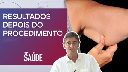 Cirurgião plástico explica tratamento para braço flácido após bariátrica | Dr. Juvenal Frizzo