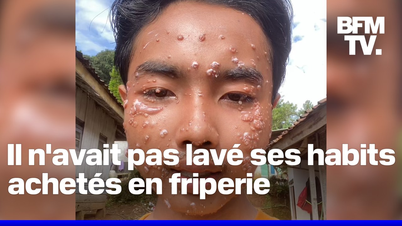 Ce tiktokteur contracte une maladie cutanée, le molluscum contagiosum, responsable de pustules sur son visage