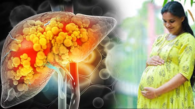 Fatty Liver In Pregnancy: प्रेगनेंसी में फैटी लिवर क्यों होता है, Causes, Symptoms & Precautions...