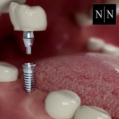 Dental Implants Explained How They Work and Why They Matter