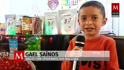 ‘Piel de mariposa’: enfermedad que padece niño en Puebla