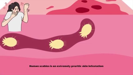 Effective Scabies Treatment METHODS Bring Relief FAST