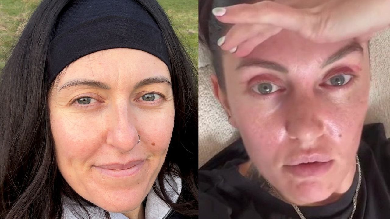 Bride has £1.1k eyelid surgery for wedding - and says it's "worth every penny"