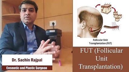 Dr. Sachin Rajpal Talks About Hair Transplant Techniques