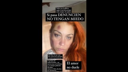 Lowrdez Fernández muestra las marcas en su rostro y acusa violencia de su ex pareja