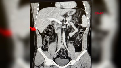 Havalimanında yakalanan 2 şüphelinin, 35 kapsül eroin yuttuğu belirlendi