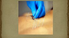 Benefits of dry needling in physiotherapy and its impact on recovery