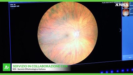 Oftalmologi, "troppi pazienti con maculopatia senza trattamento"