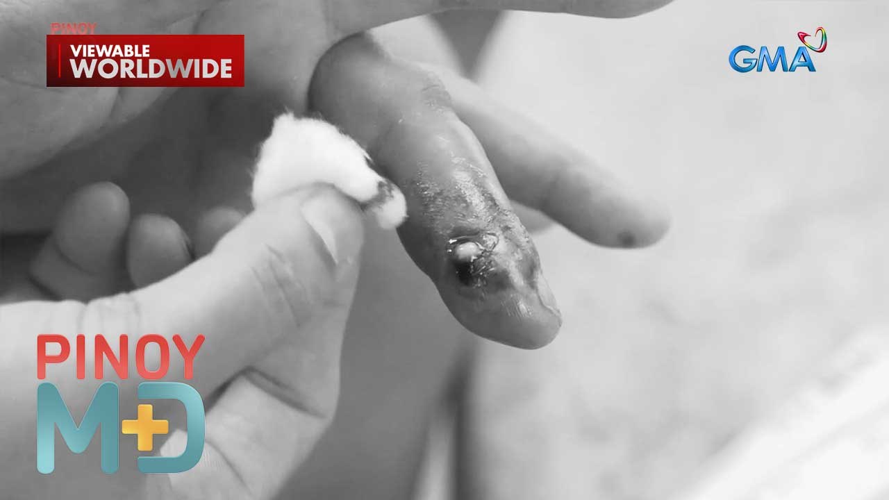Daliri ng isang babae, halos mabulok na matapos daw tubuan ng pigsa! | Pinoy MD