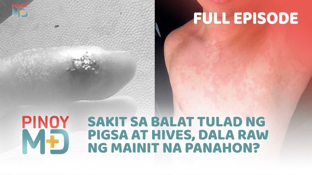 Sakit sa balat tulad ng pigsa at hives, dala raw ng mainit na panahon? (Full Episode) | Pinoy MD