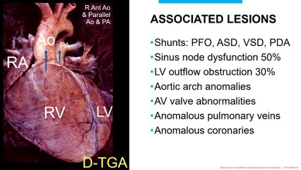 Complex Congenital Heart Disease