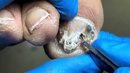 Super dirty nails, filled with germs【Pedicure 】
