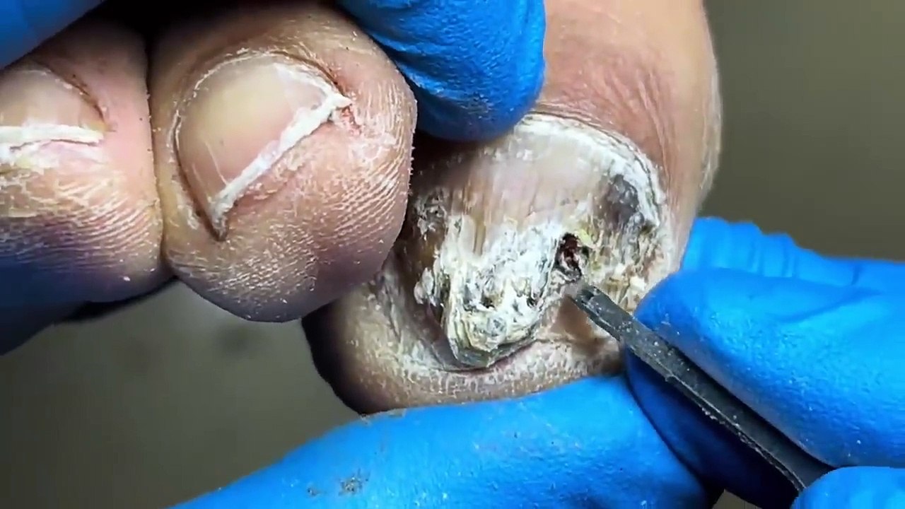 Super dirty nails, filled with germs【Pedicure 】