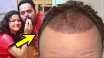 Kanpur Engineer Vineet Kumar को हुआ ये Hair Transplant Side Effect, Face पर हुई Swelling से कैसे बचे