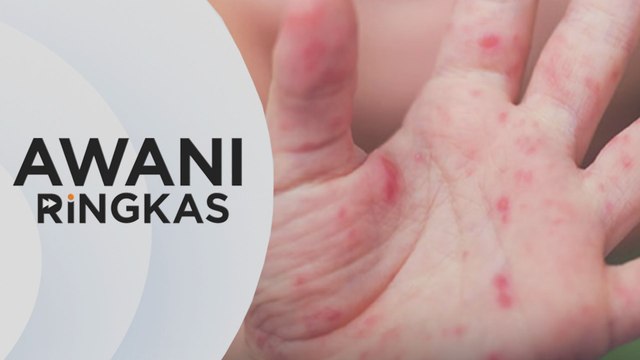 AWANI Ringkas: Kes HFMD di Kelantan meningkat lebih tiga kali ganda
