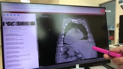 Giresun’dan dünya tıbbına yeni tanı: "Karadeniz sendromu"