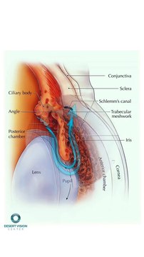 Minimally invasive glaucoma surgery (MIGS)