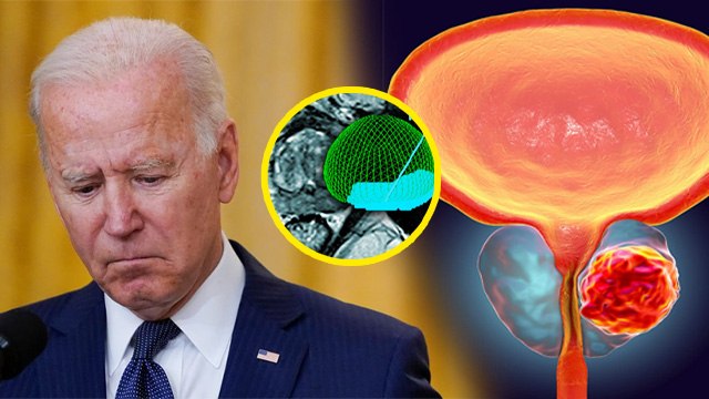 Joe Biden Aggressive Prostate Cancer:आक्रामक प्रोस्टेट कैंसर क्या है,Causes,Symptoms & Treatment...