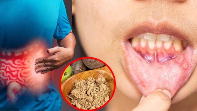Mouth Ulcers Causes: पेट खराब होने से मुंह में छाले क्यों होता है,Treatment In Hindi | Boldsky