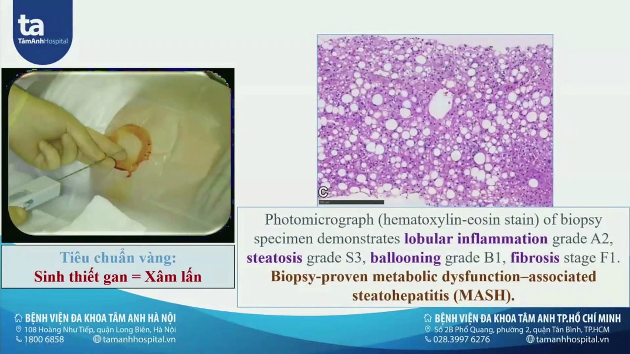 Siêu âm định lượng mỡ, đàn hồi và vi mạch trong chẩn đoán bệnh lý gan - Bs Nguyễn Quang Trọng