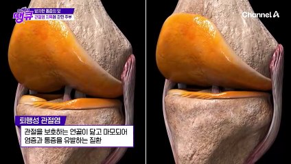 ♨퇴행성과 류머티즘의 동시 습격♨ 관절염 지옥에 갇힌 주부의 사연