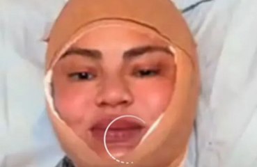 Chrissy Teigen undergoes 'hairline lowering procedure'