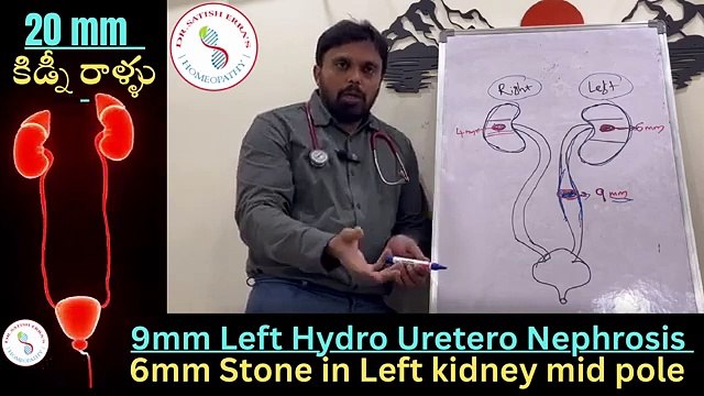 15MM Kidney Stones Treatment Without Surgery | Dr. Satish Erra