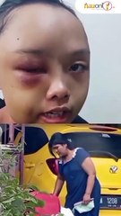 Miris, Gadis Yatim Piatu di Kampar Dianiaya Tante Sendiri