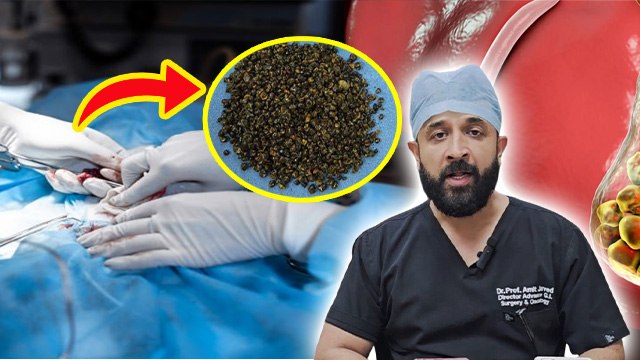 GallBladder Stones Reason: Haryana में 70 Year Old Men के निकली 8125 Stones, Symptoms and Treatment